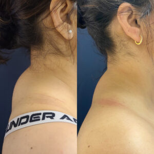 LipoSculpt Buffalo Hump Reduction Cayman Islands Before After Small