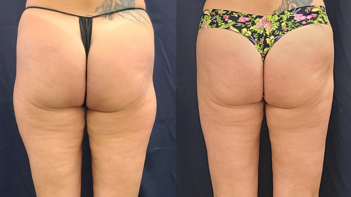LipoSculpt Saddle Bag Reduction Cayman Islands Before After Wide