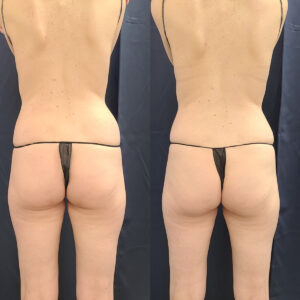 Body Contour Love Handles Waist Treatment Before After