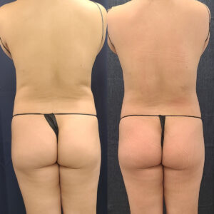 Body Contour Love Handles Waist Treatment Before After3