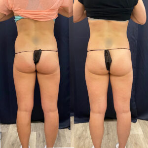 Body Contour Love Handles Waist Treatment Before After5