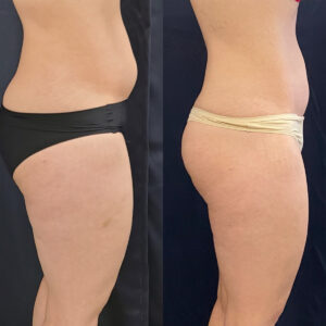 LipoSculpt Abdomen Treatment 2