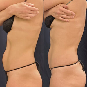 LipoSculpt Abdomen Treatment 3