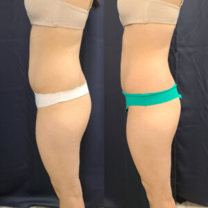 LipoSculpt Abdomen Treatment 4a