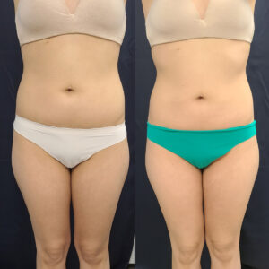 LipoSculpt Abdomen Treatment 4b