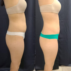 LipoSculpt Abdomen Treatment 4c