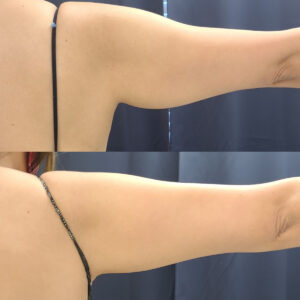 LipoSculpt Arm Fat Reduction Cayman Islands