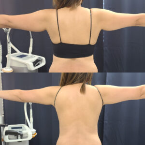 LipoSculpt Arm Treatment2jpg