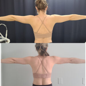 LipoSculpt Arm Treatment3