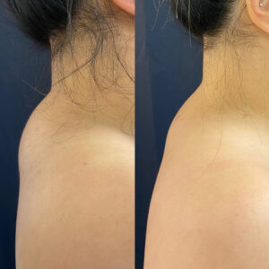 LipoSculpt Buffalo Hump Reduction Cayman Islands Before After Small 2