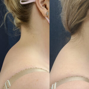 LipoSculpt Buffalo Hump Reduction Cayman Islands Before After Small 3