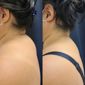LipoSculpt Buffalo Hump Reduction Cayman Islands Before After Small 4