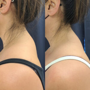 LipoSculpt Buffalo Hump Reduction Cayman Islands Before After Small 5