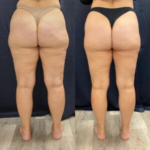 LipoSculpt Cellulite Treatment Cayman Islands Before After2