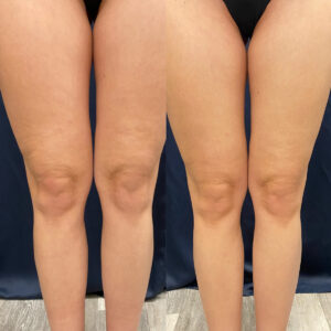 LipoSculpt Cellulite Treatment Cayman Islands Before After3