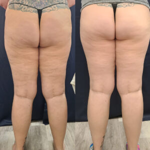 LipoSculpt Cellulite Treatment Cayman Islands Before After4
