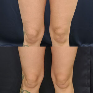 LipoSculpt Knees Treatment Cayman Islands Before After