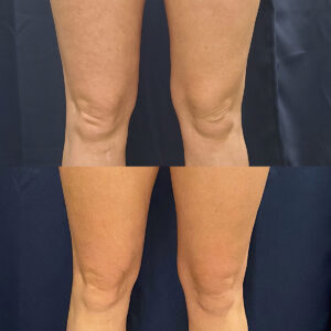 LipoSculpt Knees Treatment Cayman Islands Before After2