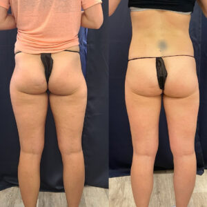 LipoSculpt Saddlebag Treatment Cayman Islands Before After