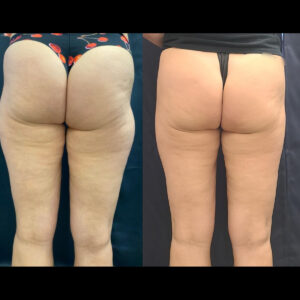 LipoSculpt Saddlebag Treatment Cayman Islands Before After2