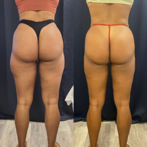 LipoSculpt Saddlebag Treatment Cayman Islands Before After3