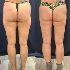 LipoSculpt Saddlebag Treatment Cayman Islands Before After4