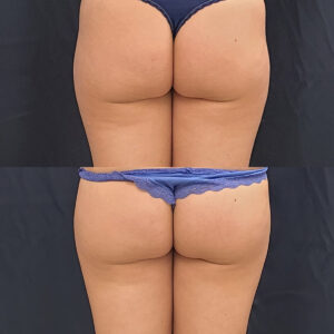 LipoSculpt Saddlebag Treatment Cayman Islands Before After5