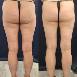 LipoSculpt Saddlebag Treatment Cayman Islands Before After7
