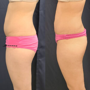 LipoSculpt Tummy Flattening Cayman Islands
